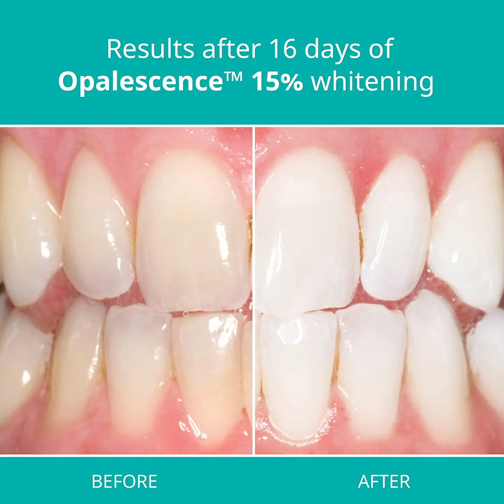 Opalescence Professional White - Teeth Whitening Gel Opalescence review and price
