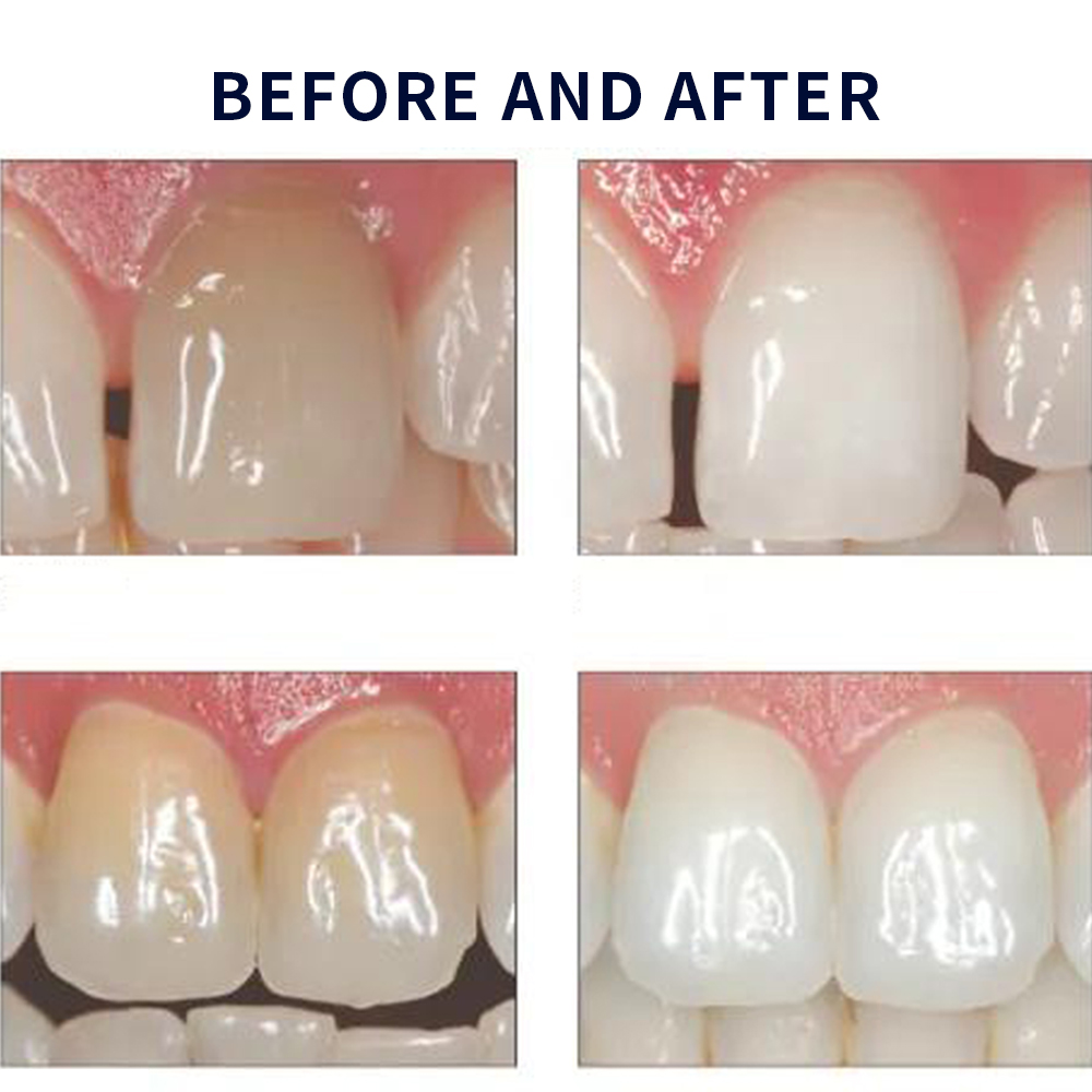Opalescence Whitening 20% PF 2 - Teeth Whitening Gel Peroxide review and price