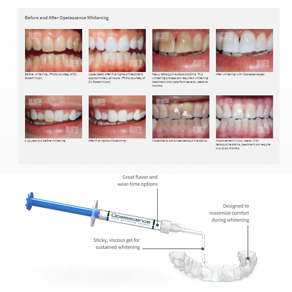 Opalescence Whitening 20% PF 2 - Teeth Whitening Gel Peroxide review and price